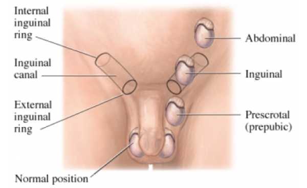 CAUSES, EFFECTS AND TREATMENT OF UNDESCENDED TESTICLES