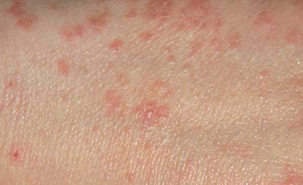 What To Do If Your Child Has Scabies