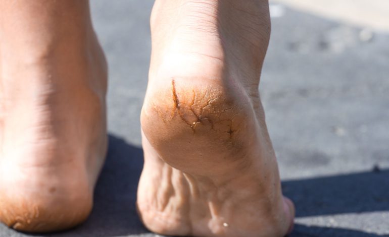 7 ways to deal with cracked heels