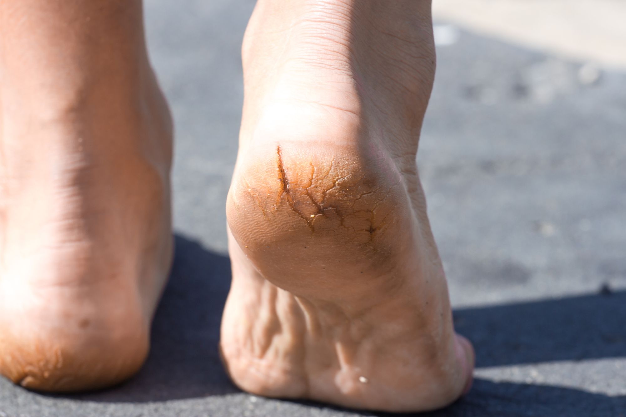 7 ways to deal with cracked heels