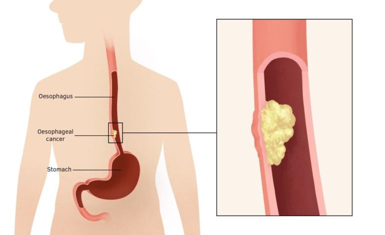 8 facts about cancer of the oesophagus