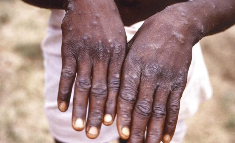 9 succumb to Monkeypox in Congo