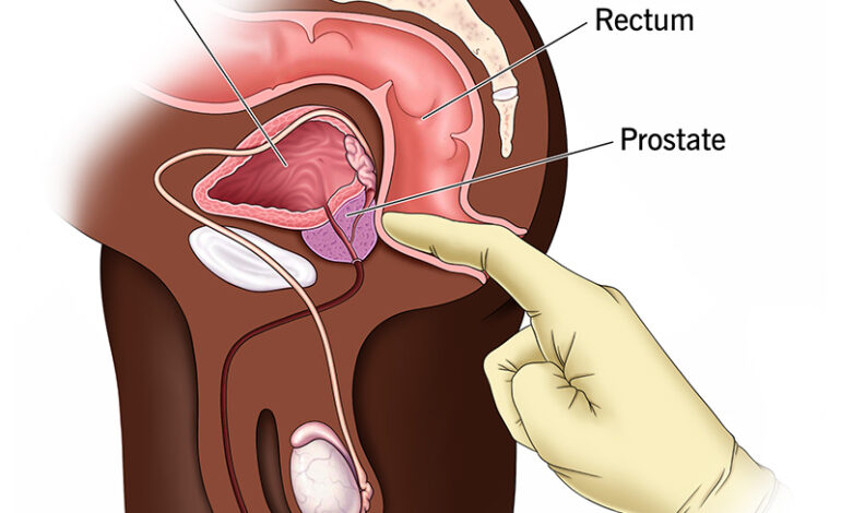 Why doctors insert a finger to check for prostate cancer