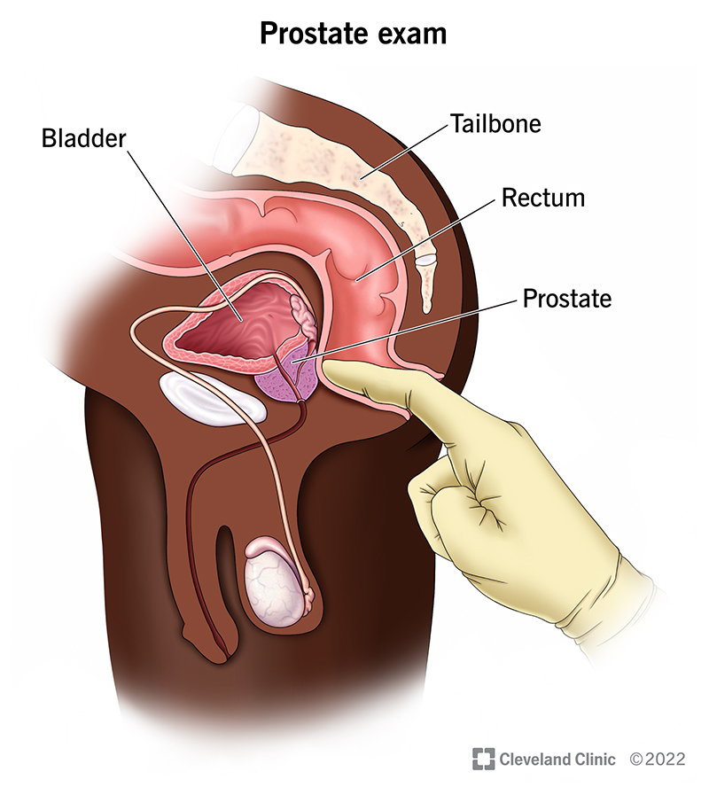 Why doctors insert a finger to check for prostate cancer